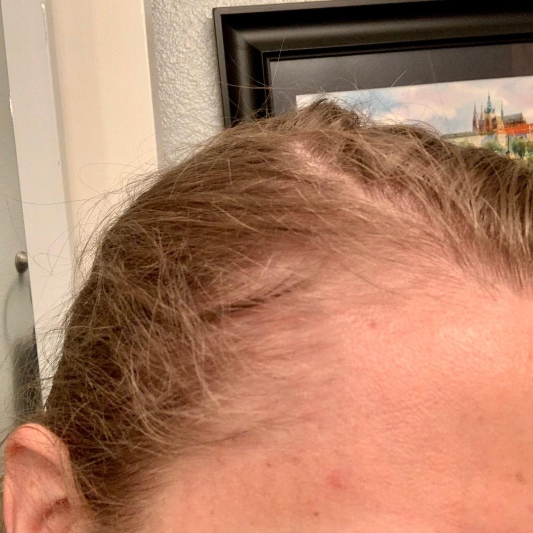 Hair line right (before Nutrafol)