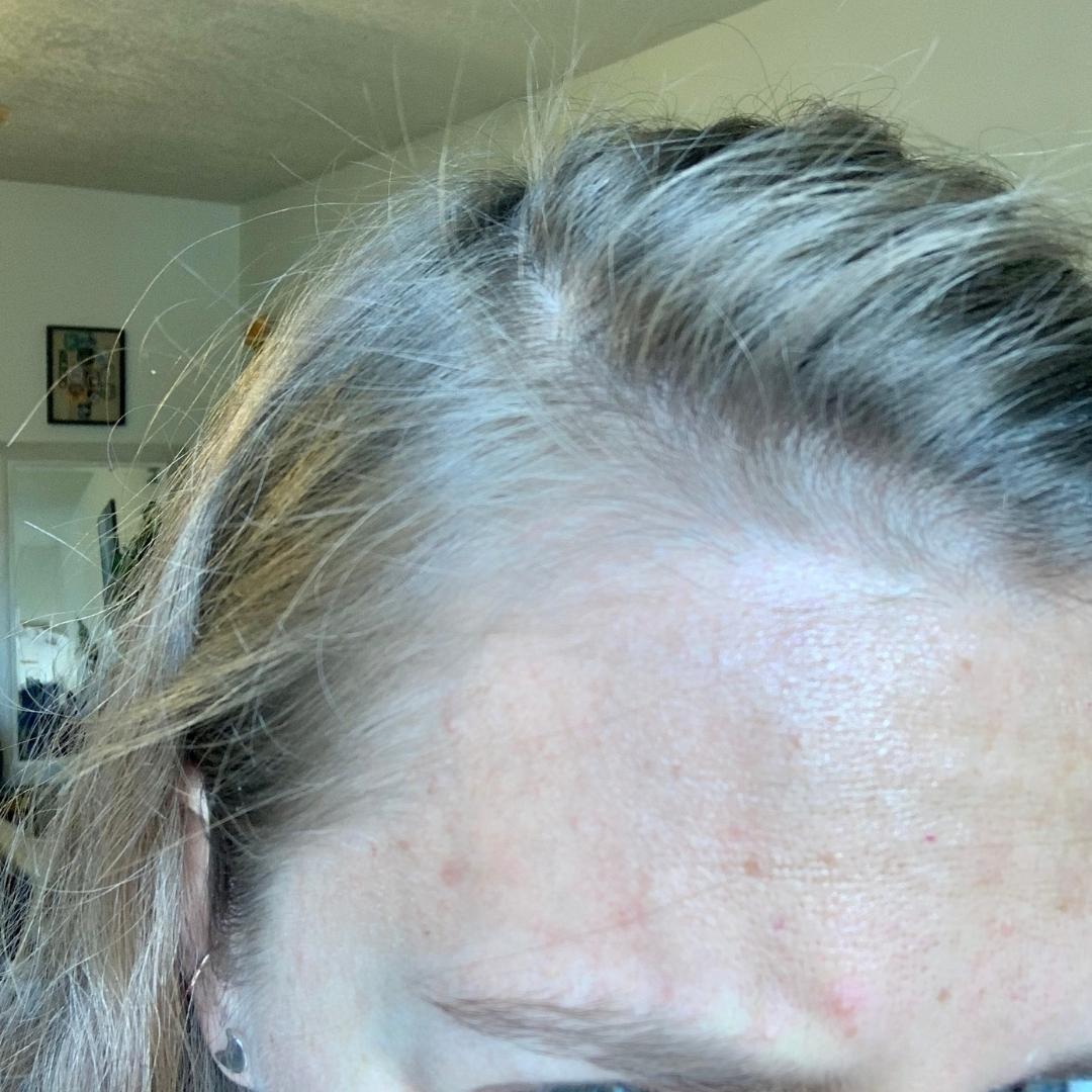 Hairline right (one month after Nutrafol)